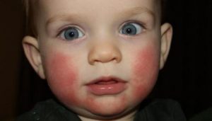 Почему у ребенка красные щеки