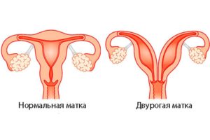 Беременность и двойная матка