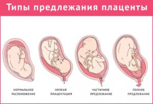 Форум низкое расположение плаценты при беременности 20 недель