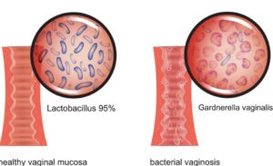 Лечение гарднерелла при беременности