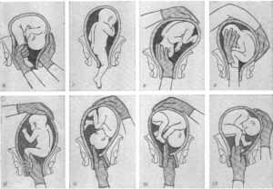 Если ребенок не перевернулся головкой вниз перед родами