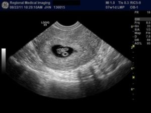 7 эмбриональная неделя беременности