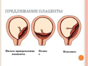 Низкое прикрепление плаценты при беременности 20 недель