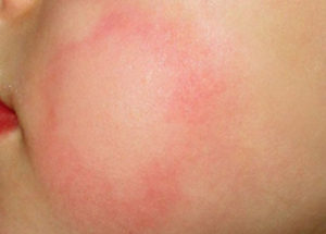 Аллергия на кондиционер у ребенка