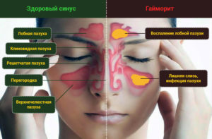 Как лечить гайморит в домашних условиях у беременных