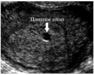 Плодное яйцо в нижней трети полости матки последствия