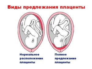 Плацента расположена по задней стенке в дне матки