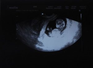 Беременность 11 недель 3 дня