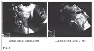 Шейка матки 28 мм при беременности 28 недель