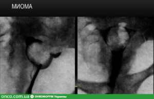 Миома задней стенки матки