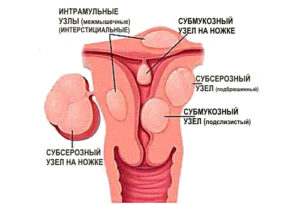 Интерстициальный узел матки по передней стенке при беременности