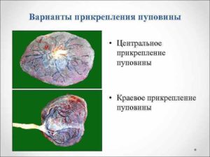 Краевое прикрепление пуповины к плаценте чем грозит