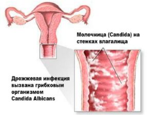 Молочница признак беременности форум