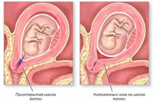 Как снимают швы с шейки матки при беременности
