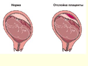 Небольшая отслойка плаценты на ранних сроках беременности форум