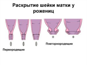 Как быстро может укоротиться шейка матки при беременности