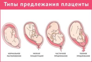 Плацента по передней стенке и шевеления плода форум