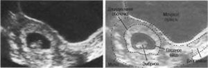 Низкое прикрепление плодного яйца на раннем сроке