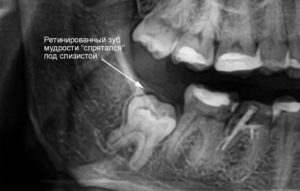 Зуб мудрости в 15 лет