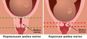 Шейка матки короткая при беременности 34 недели беременности