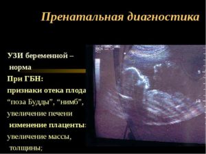 Отечная плацента при беременности