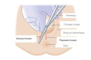 После родов грануляция шва