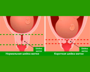 Шейка матки сколько должна быть см