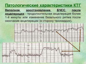 Акцелерации на ктг норма