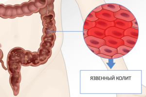 Язвенный колит кишечника у грудничка