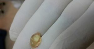 Как выглядит плодное яйцо при медикаментозном аборте