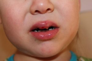 Ребенок разбил губу чем лечить