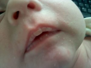 Белая корочка на губах у новорожденных