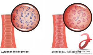 Gardnerella vaginalis при беременности