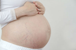 Как начинаются растяжки на животе при беременности