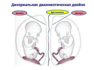 Беременность двойня диамниотическая двойня