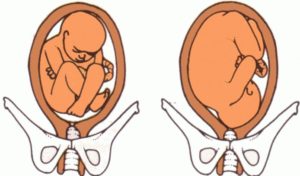 Если ребенок не перевернулся головкой вниз перед родами