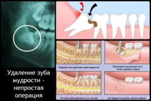 Зуб мудрости как долго растет