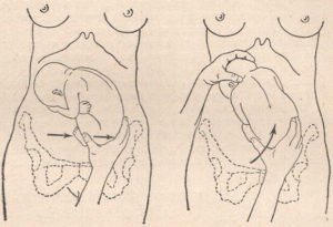 Упражнения для поворота плода в головное предлежание