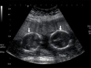 15 недель беременности двойня