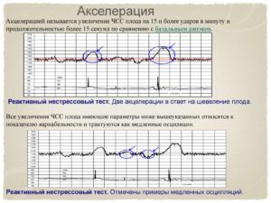 Акцелерации на ктг норма
