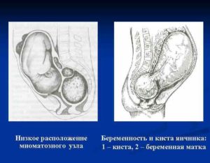 Низко расположена матка при беременности