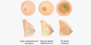 Грудь меньше стала болеть на 6 неделе беременности