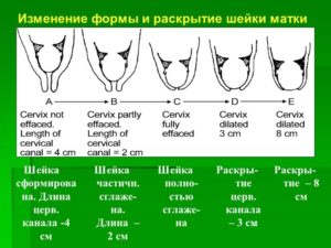 Как быстро может укоротиться шейка матки при беременности