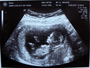 Беременность 11 недель 6 дней