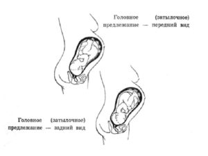 Предлежание плода головное 2 позиция передний вид