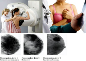 Маммография и планирование беременности
