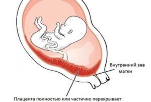 Плацента по задней стенке матки что это означает