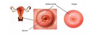 Почему шейка матки красная