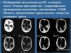 Расширение бокового желудочка головного мозга у плода