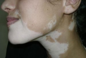 Нарушение пигментации кожи у детей